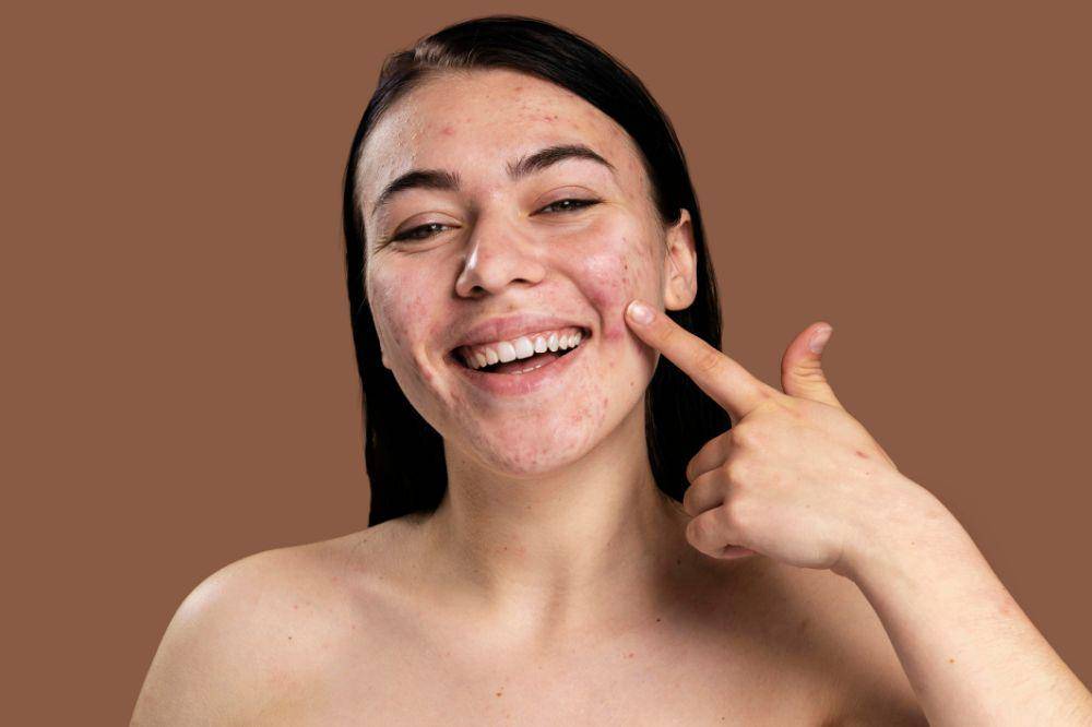 Tips Makeup di Kulit Berminyak dan Berjerawat agar Tahan Seharian