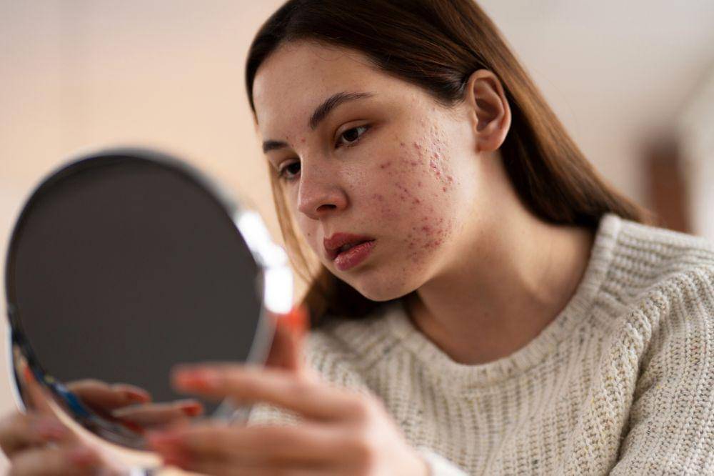 Benarkah ASI Dapat Mengatasi Jerawat? Cek Faktanya!