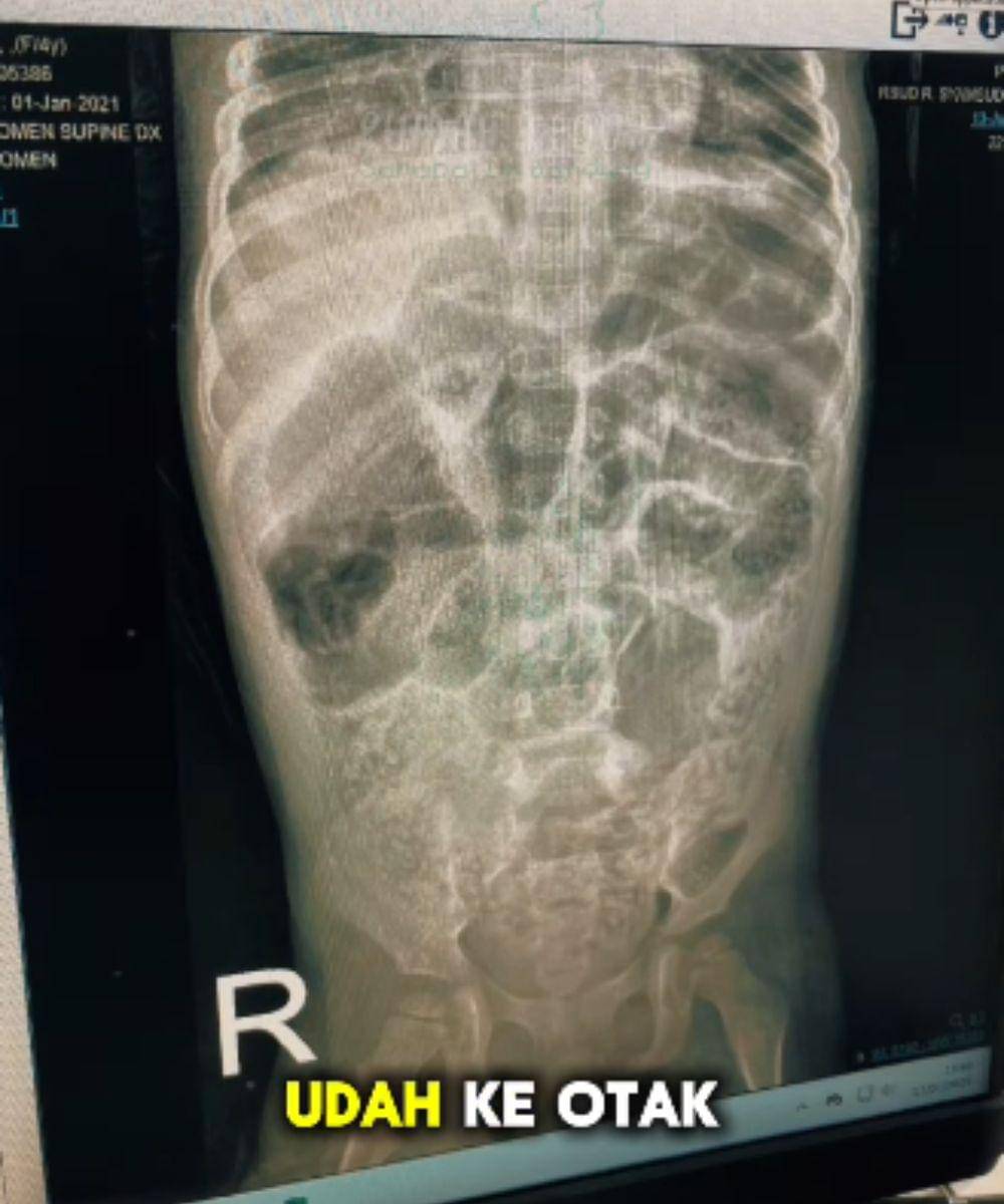 bocah anak 4 tahun meninggal karena cacing