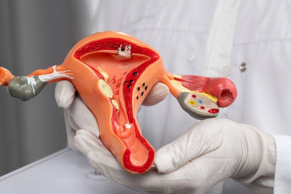 Gejala Kanker Serviks yang Perlu Diwaspadai Sejak Dini