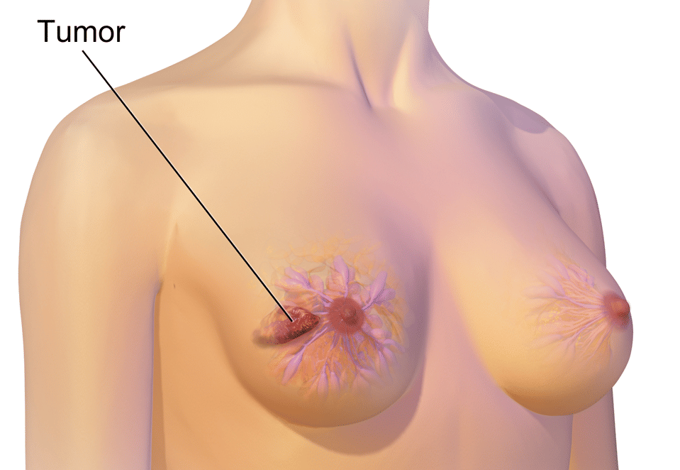 ilustrasi kanker payudara