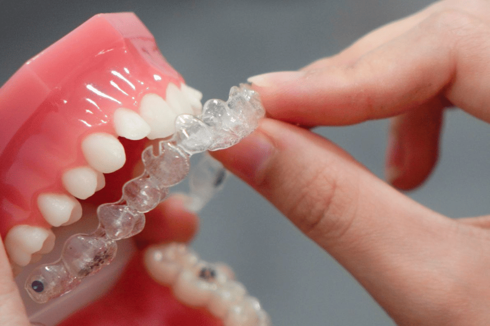 Apa itu retainer .png