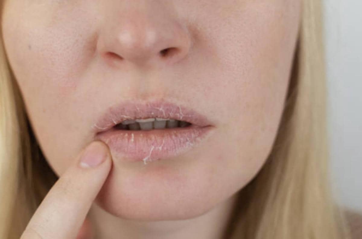 Benarkah Sering Mengelupas Bibir Tanda Gangguan Psikologis?