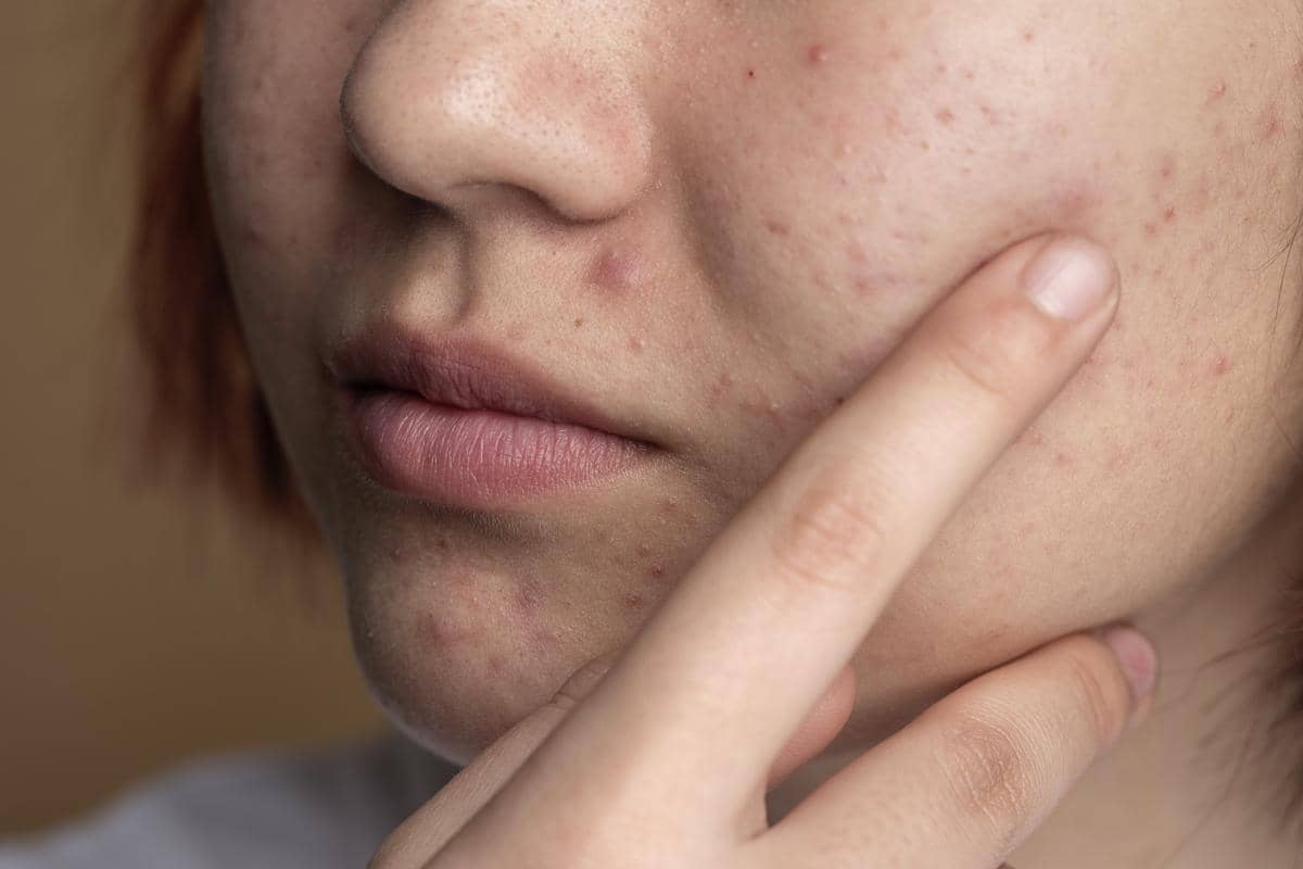 5 Cara Mencegah Bekas Jerawat saat Hamil, Kuncinya Telaten