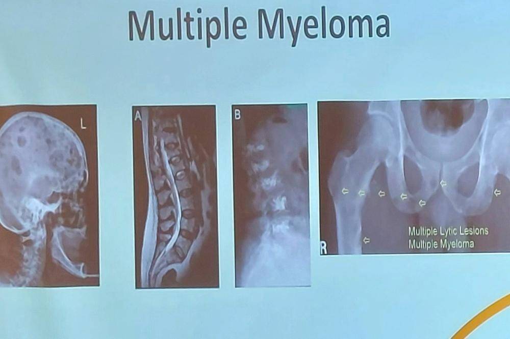 Kenali Multiple Myeloma di Bulan Kesadaran Kanker Darah 2025 (3).jpg