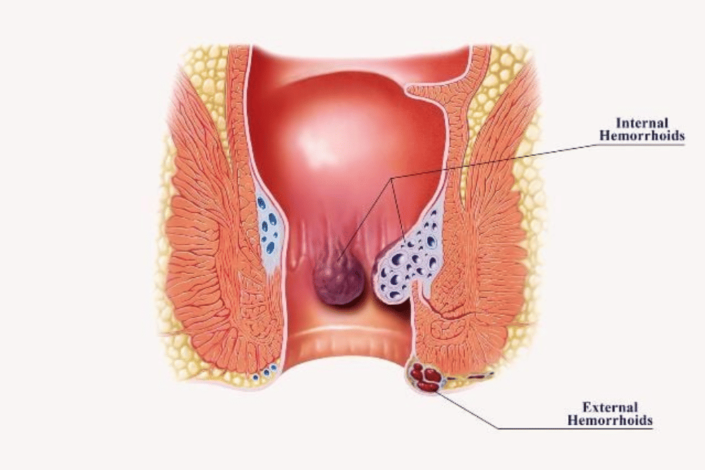 Hemoroid atau ambeien