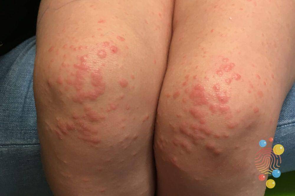 gcs penyakit kulit langka