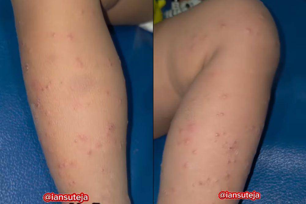 gcs penyakit kulit langka