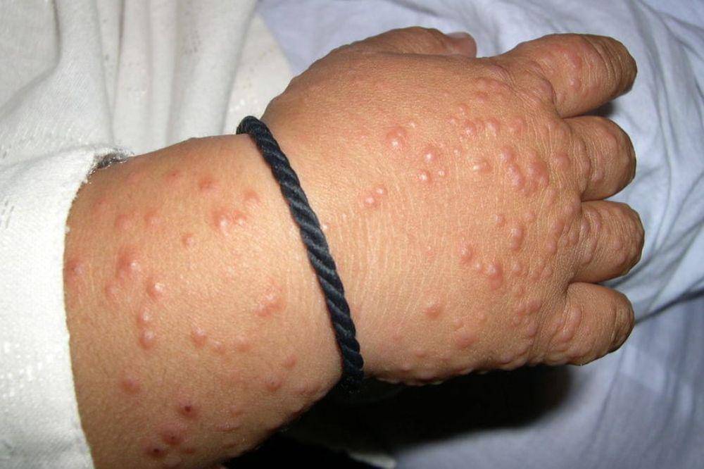 gcs penyakit kulit langka 