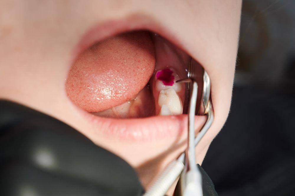 Hubungan Kesehatan Gigi dan Gusi terhadap Hormon, Pengaruhi Reproduksi