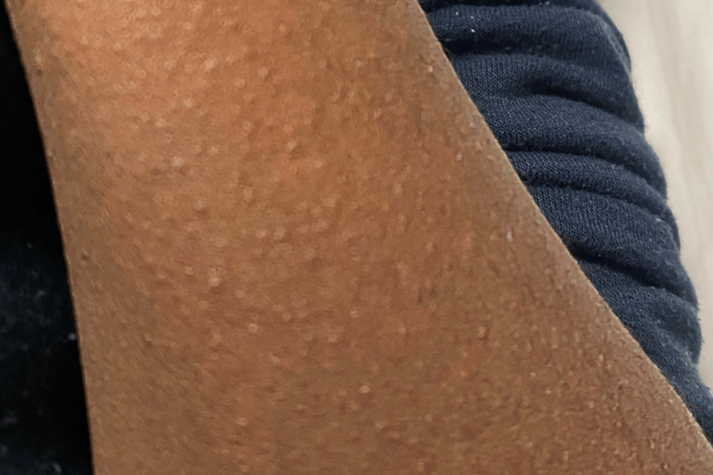 Apa itu Demam Scarlet Kenali Penyebab, Gejala, dan Penanganan 3.png