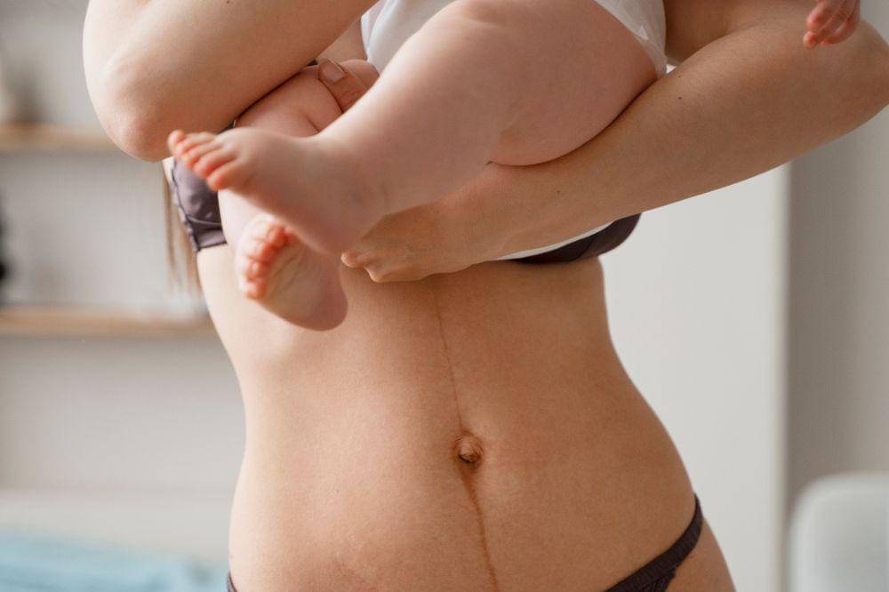 Cara Mengatasi Kulit Perut Menghitam setelah Melahirkan Menurut Ahli