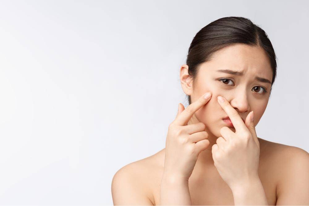 Rekomendasi Obat Totol Jerawat Lokal untuk Hempaskan Jerawat.jpg