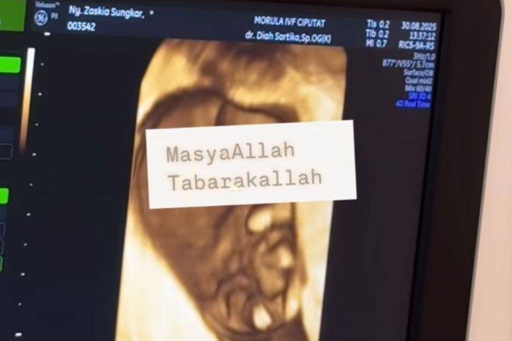 Perjalanan Zaskia Sungkar dan Irwansyah Jalani Program Hamil Kedua