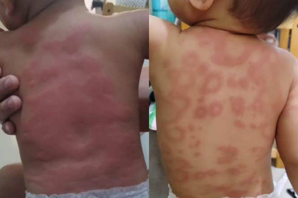 anak alergi gluten free palsu