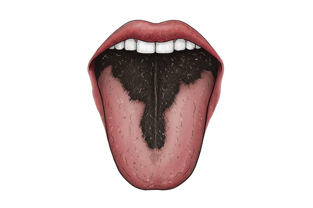 Lidah hitam dan berbulu.jpg