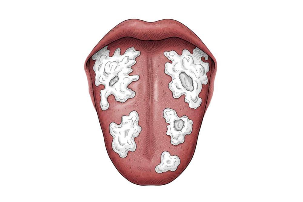 Lidah dengan bercak putih tebal atau luka puti.jpg