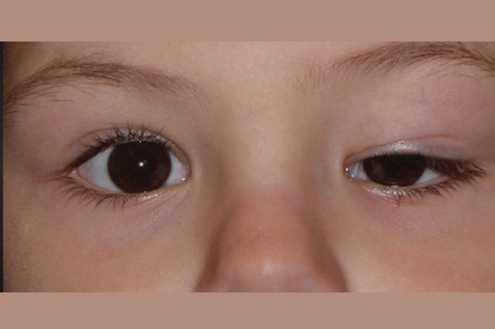 kelopak mata anak menutup sebagian