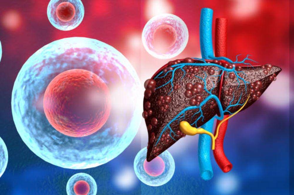 Gejala dan Faktor Kanker Hati HCC Menurut Dokter, Waspadai Sejak Dini!