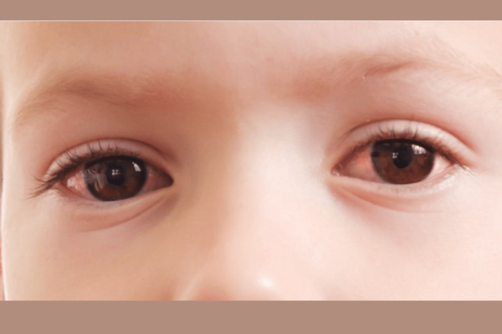 mata merah pada anak