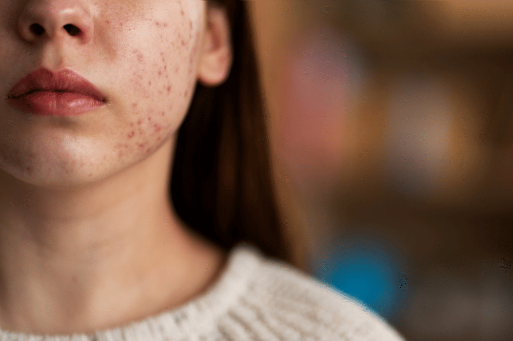 jerawat tanda pubertas