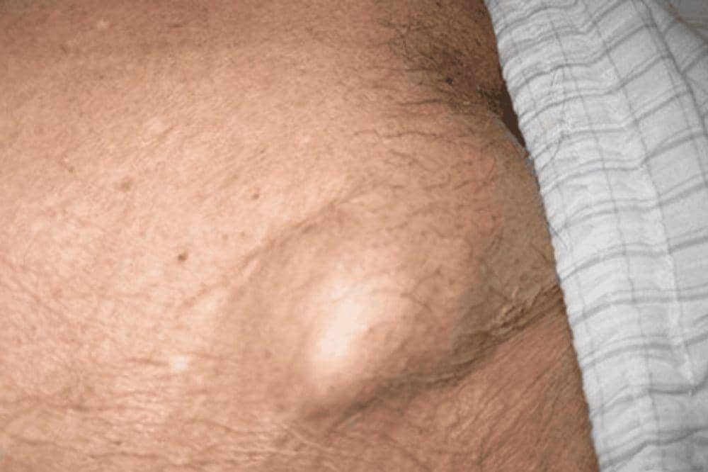 10 Ciri-Ciri Kelenjar Getah Bening, Waspadai Jika Muncul Gejala Ini (2).jpg