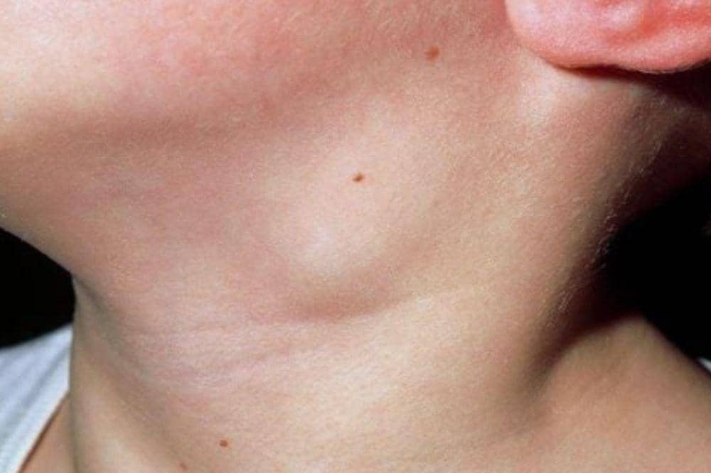 7 Tanda Kelenjar Getah Bening Bengkak, Bisa Jadi Pertanda Penyakit (1).jpg