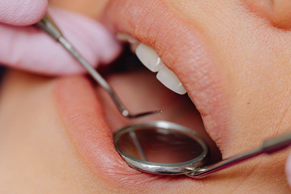 Waspada! Radang Gusi Parah Ibu Hamil Bisa Sebabkan Komplikasi ke Janin