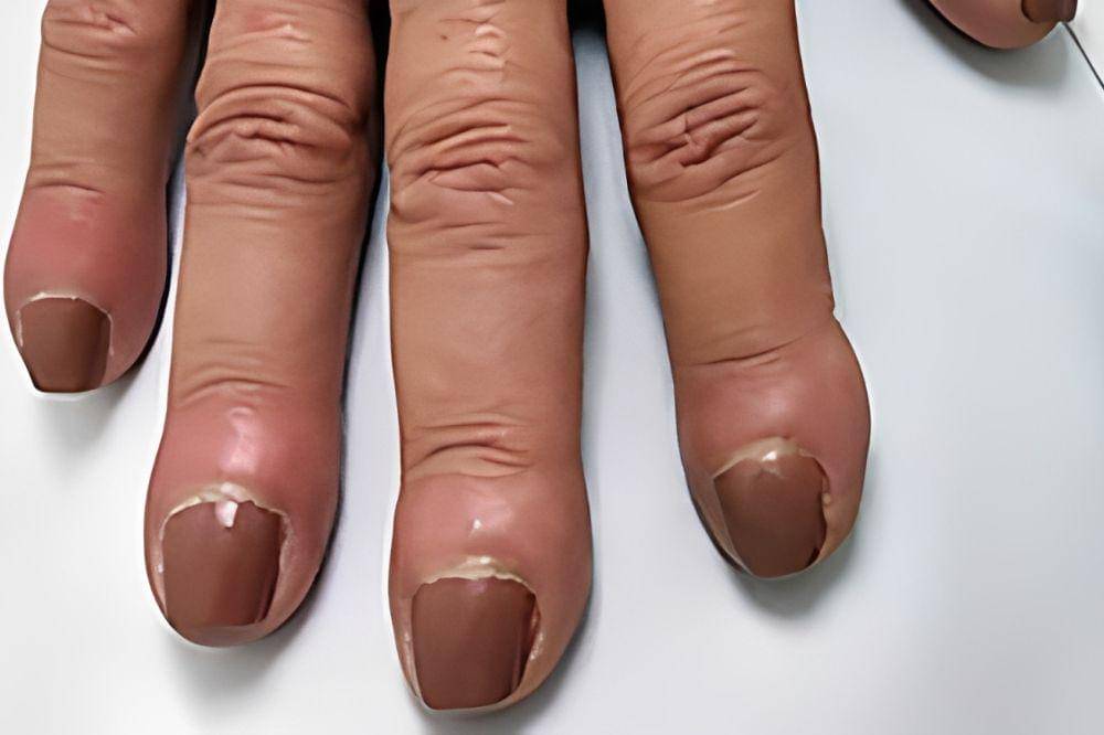 9 Tanda Masalah Kesehatan yang Terlihat dari Warna Kuku, Cek Sekarang! (6).jpg
