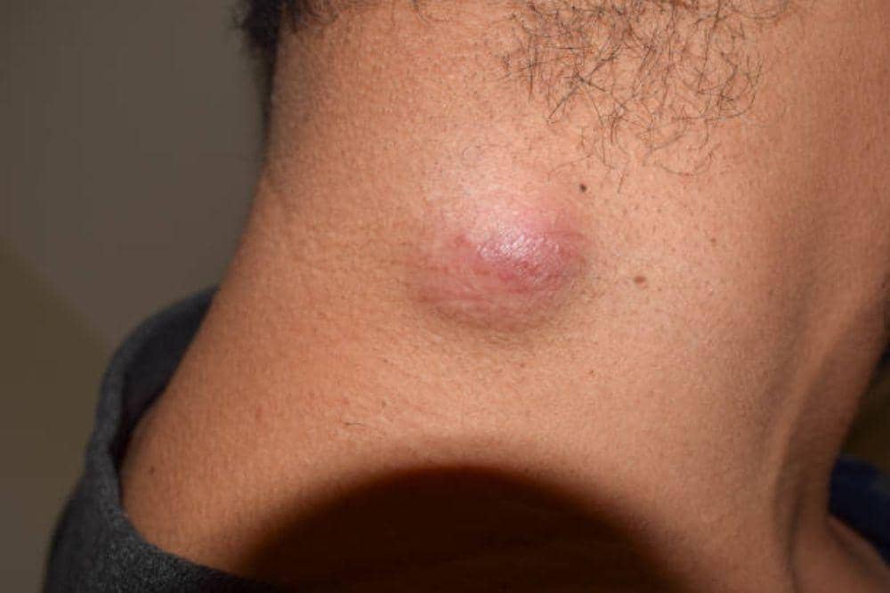 Bagaimana Bentuk Kelenjar Getah Bening? Kenali Lokasinya! | Popmama.com