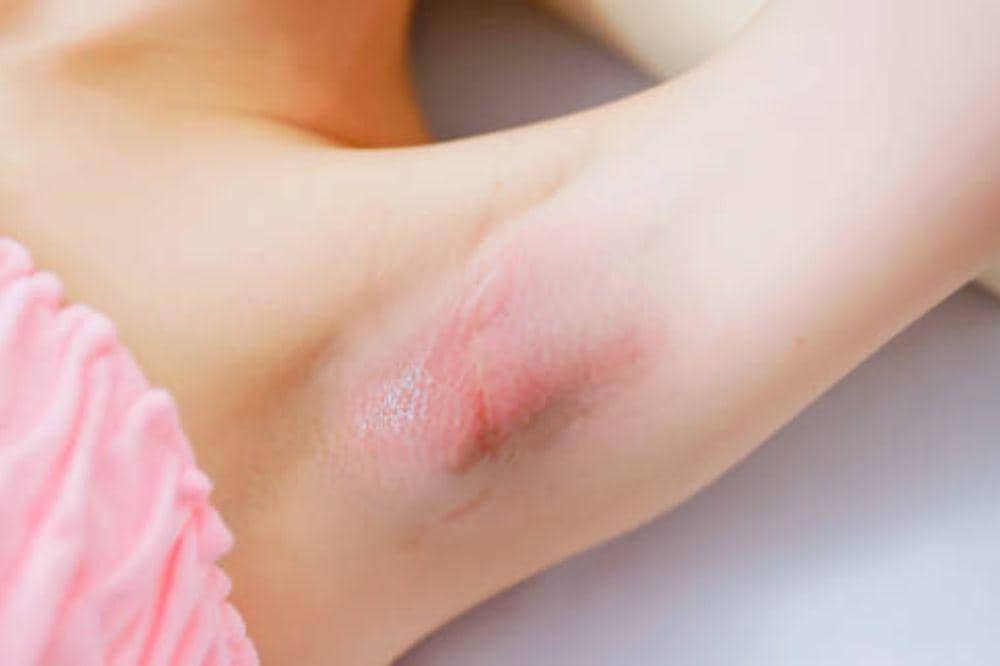 Bagaimana Bentuk Kelenjar Getah Bening? Kenali Bentuk dan Lokasinya!