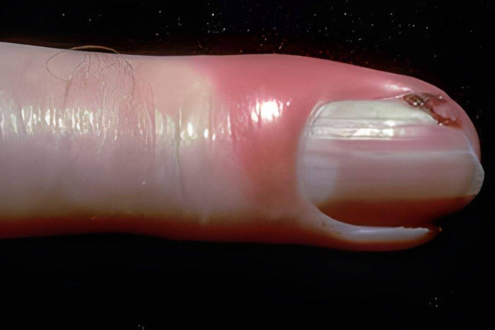 9 Tanda Masalah Kesehatan yang Terlihat dari Warna Kuku, Cek Sekarang! (8).jpg