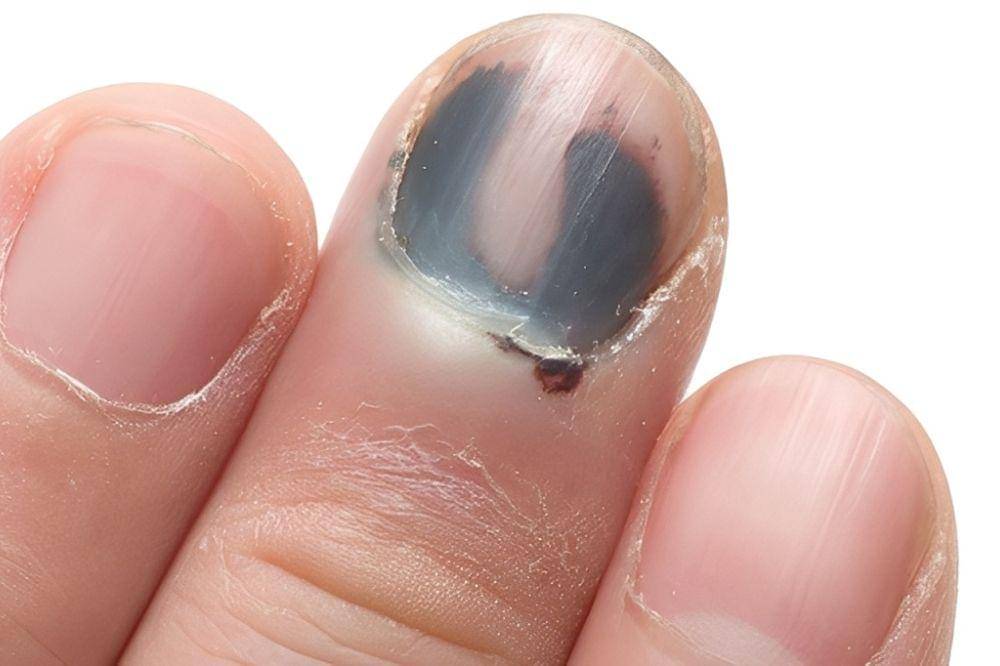 9 Tanda Masalah Kesehatan yang Terlihat dari Warna Kuku, Cek Sekarang! (4).jpg