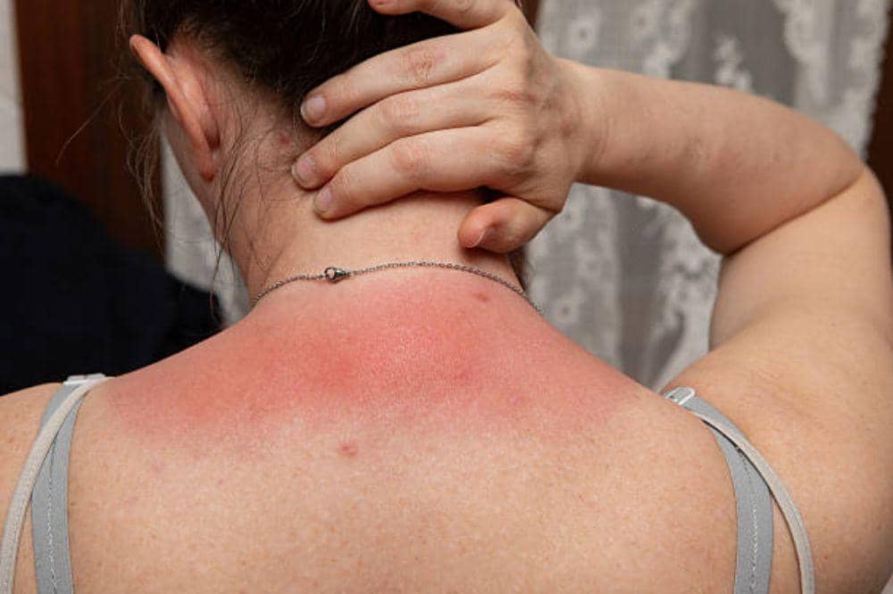 8 Efek Operasi Kelenjar Getah Bening yang Perlu Mama Ketahui