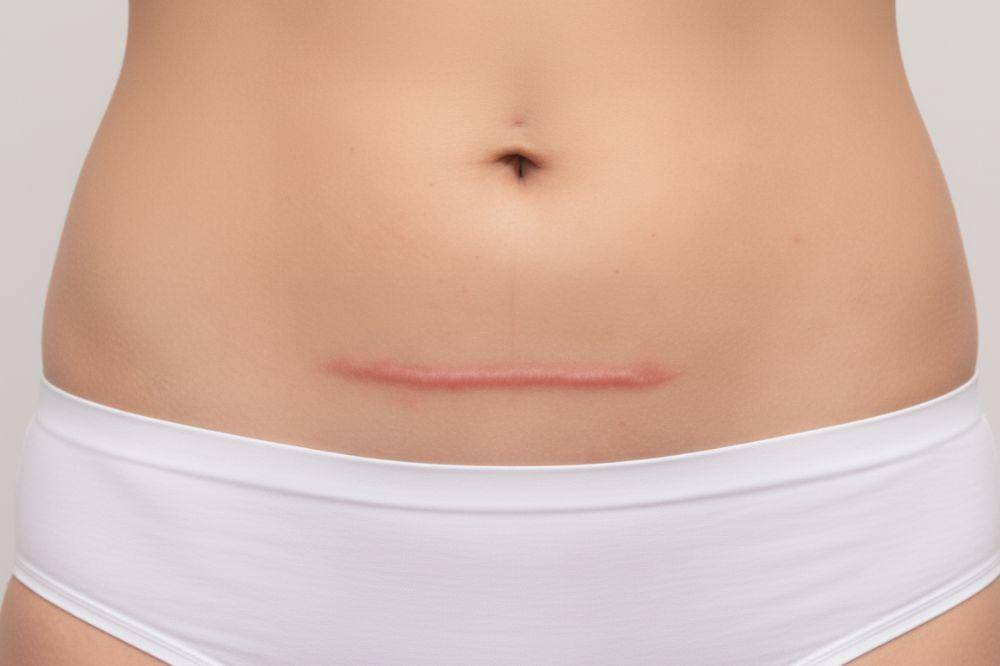 Penyebab Luka Caesar Menjadi Keloid dan Cara Mengatasinya
