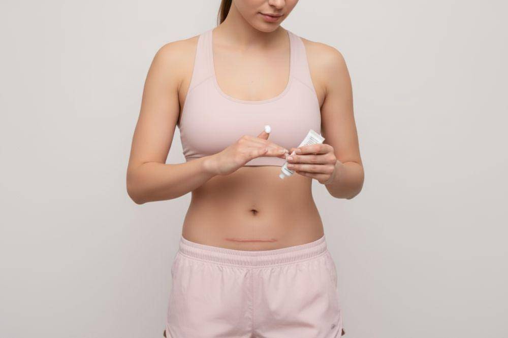 Penyebab Luka Caesar Menjadi Keloid dan Cara Mengatasinya