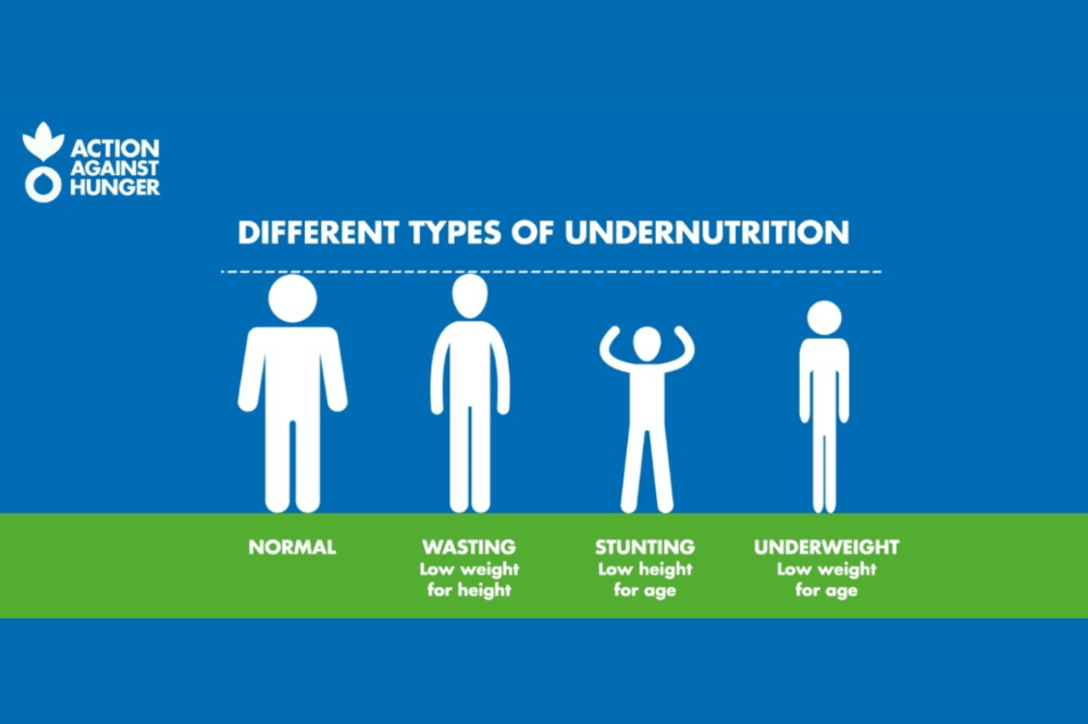 malnutrisi dan contohnya