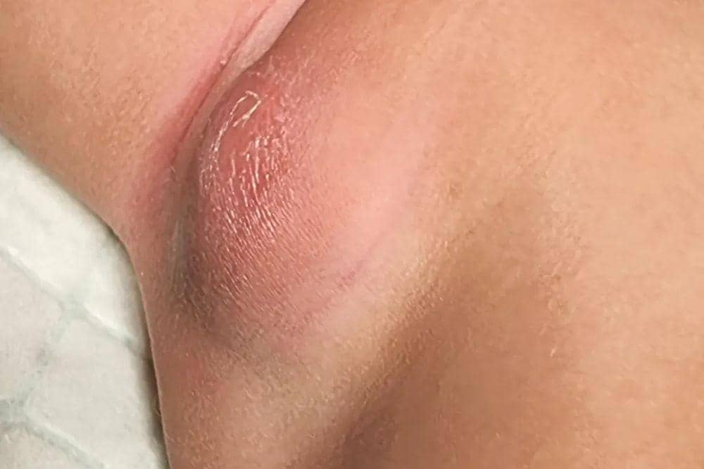 10 Penyebab dan Gejala Kelenjar Getah Bening di Ketiak, Jangan Abaikan.jpg