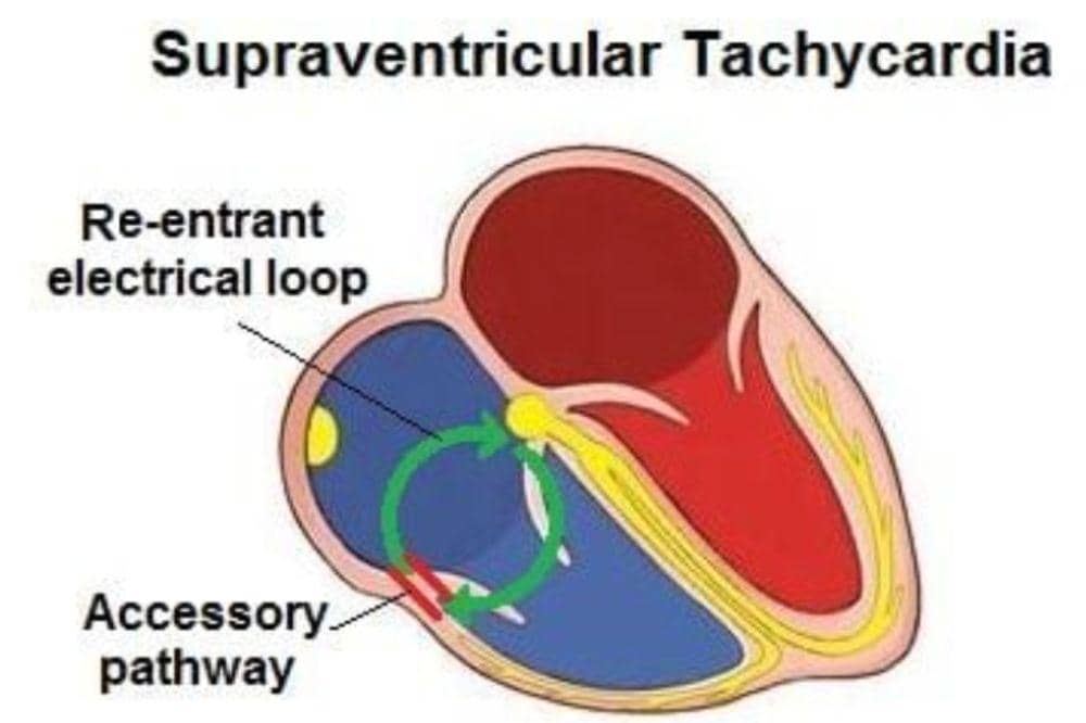 7 Jenis-Jenis Aritmia yang Perlu Mama Ketahui