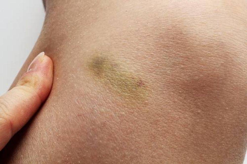 Pembengkakan Kelenjar Getah Bening di Ketiak, Cek Disini!