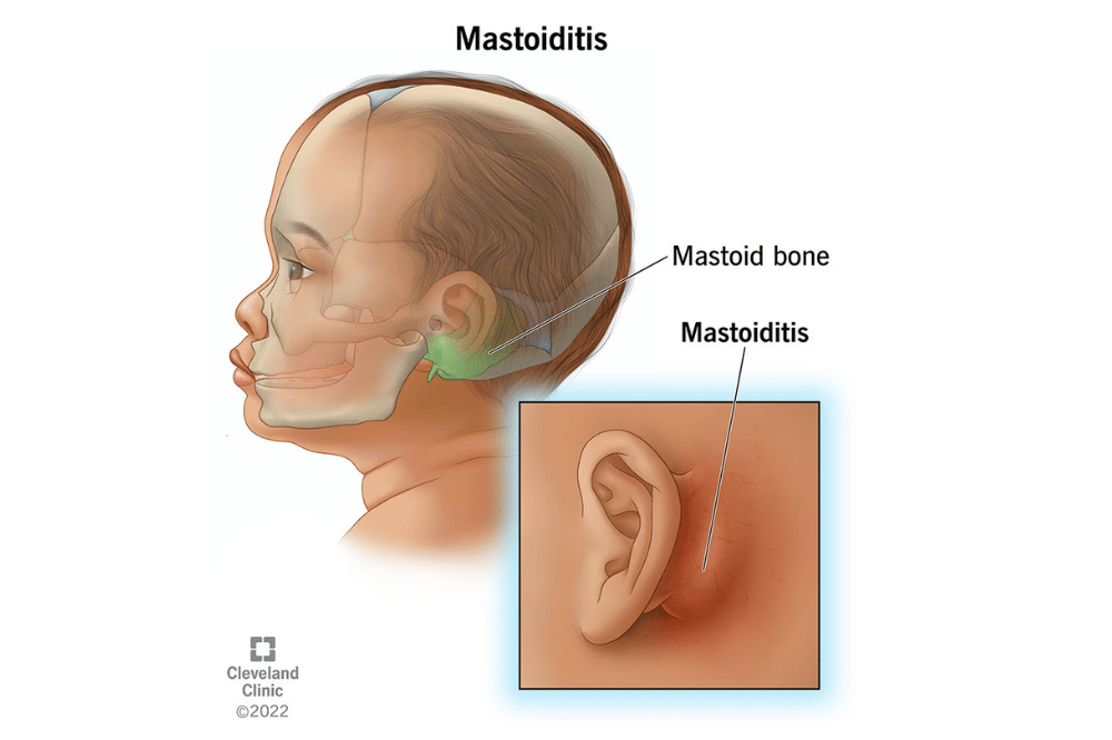 posisi benjolan pada belakang telinga anak