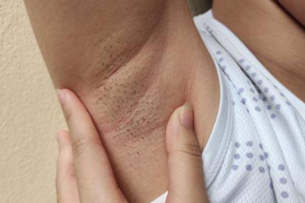 Pembengkakan Kelenjar Getah Bening di Ketiak, Cek Disini!