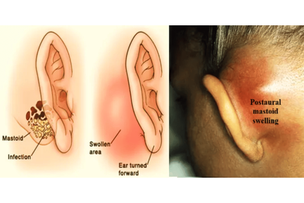 Kelenjar Getah Bening