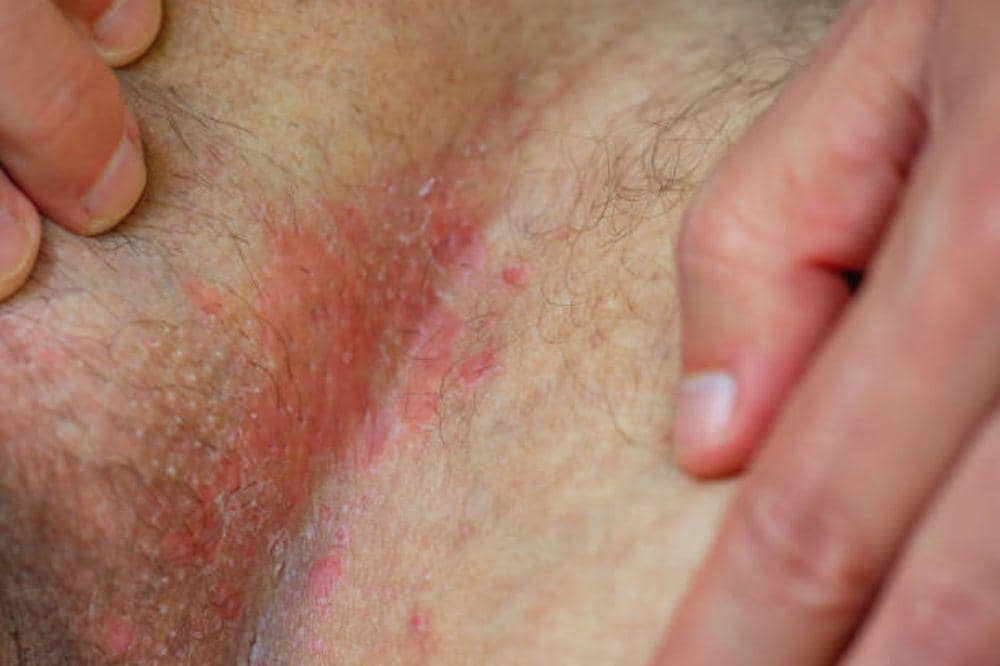 Pembengkakan Kelenjar Getah Bening di Ketiak, Cek Disini!