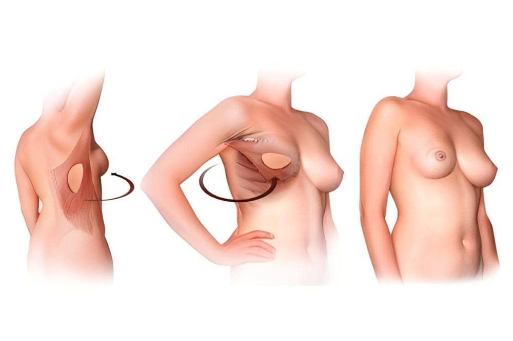 5 Jenis Operasi Kanker Payudara yang Sering Direkomendasikan Dokter (4).jpg