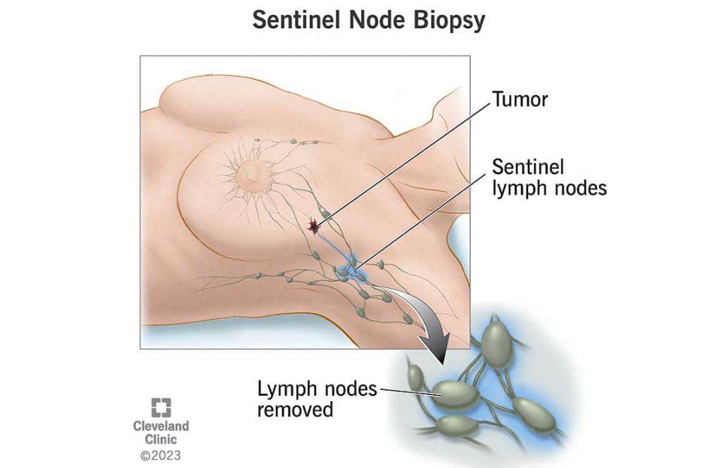 5 Jenis Operasi Kanker Payudara yang Sering Direkomendasikan Dokter (2).jpg