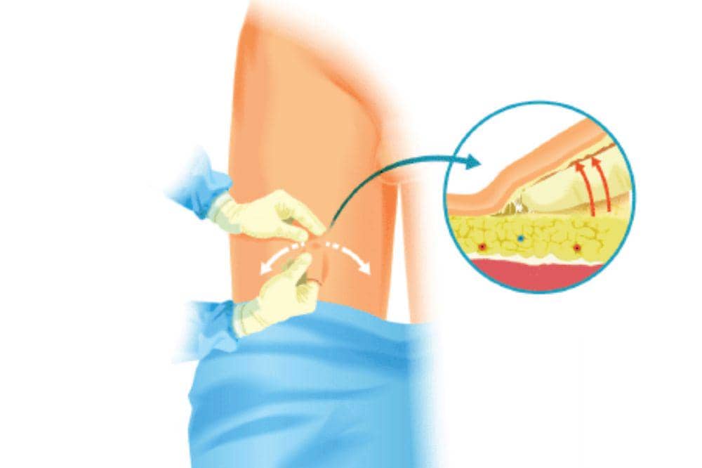 5 Jenis Operasi Kanker Payudara yang Sering Direkomendasikan Dokter (3).jpg