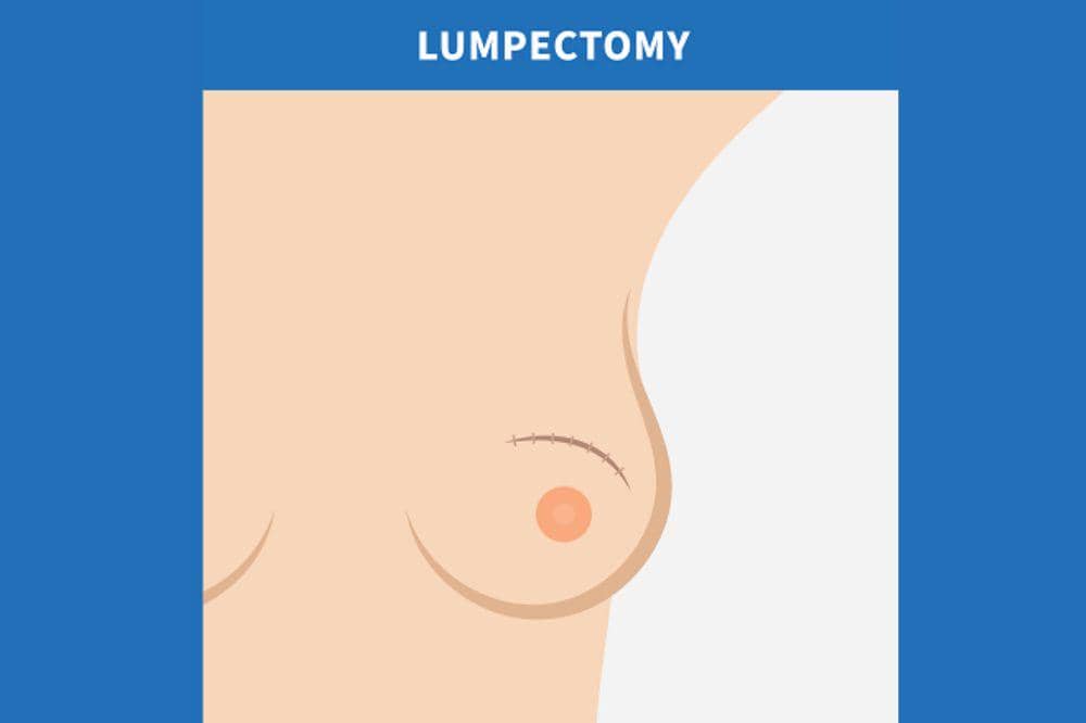 5 Jenis Operasi Kanker Payudara yang Sering Direkomendasikan Dokter.jpg