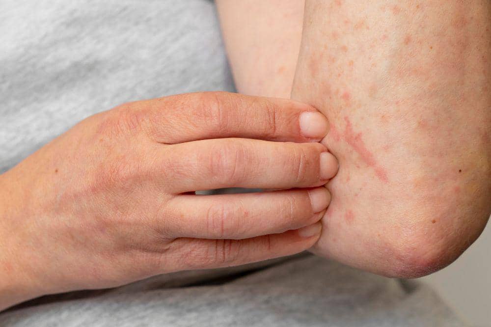 7 Cara Menghilangkan Biduran dengan Cepat agar Kulit Cepat Tenang