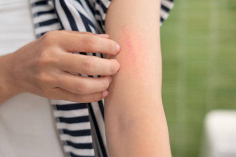 6 Gejala Biduran Menurut Ahli yang Paling Umum Terjadi